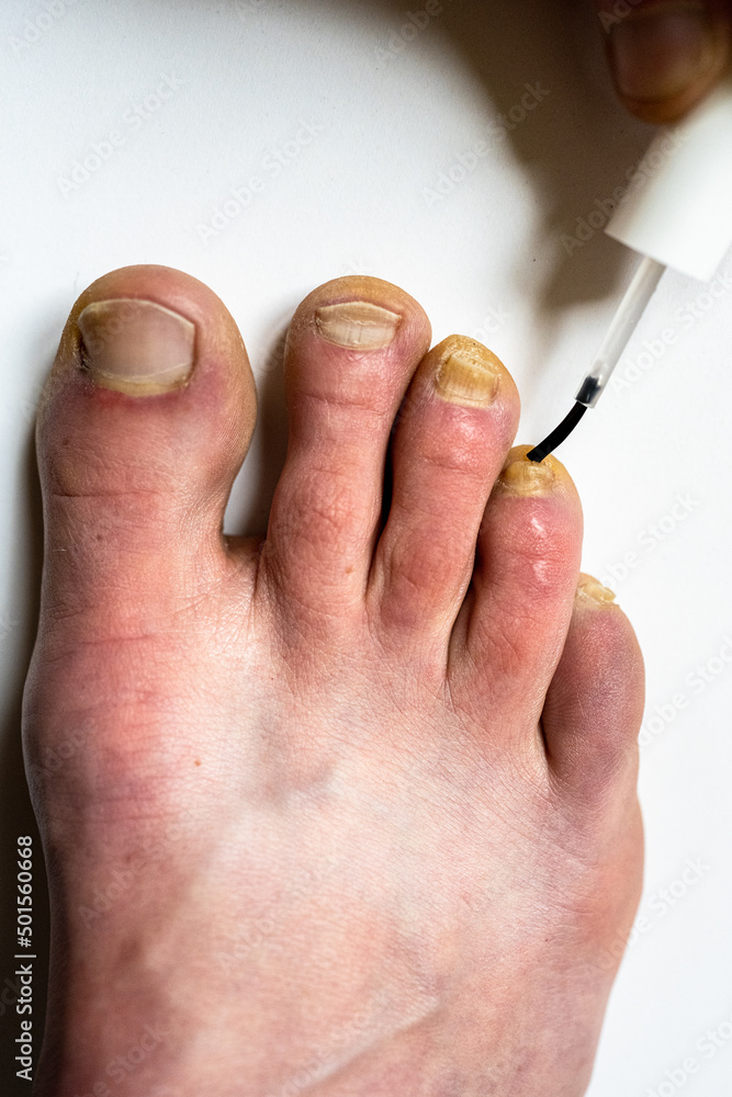 Fototapeta premium Using a varnish against nail fungus. Nail fungal infection treatment.