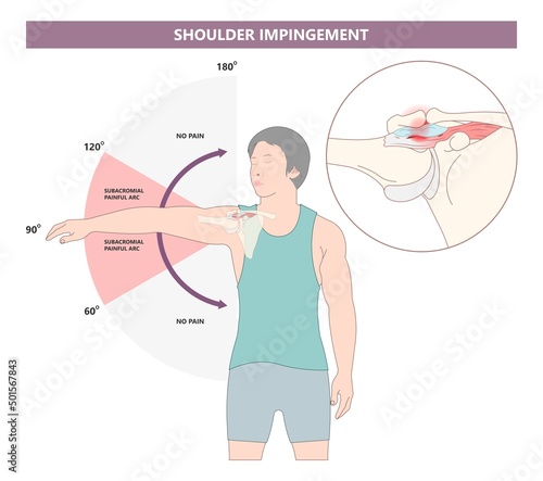 Rotator cuff SLAP tear torn pain injury tendon muscle joint X-ray range of motion space arm arc spur bone bursa sport overuse biceps tendinopathy labral tears rehab bankart lesion dislocated glenoid