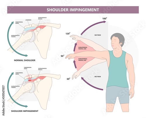 Rotator cuff SLAP tear torn pain injury tendon muscle joint X-ray range of motion space arm arc spur bone bursa sport overuse biceps tendinopathy labral tears rehab bankart lesion dislocated glenoid