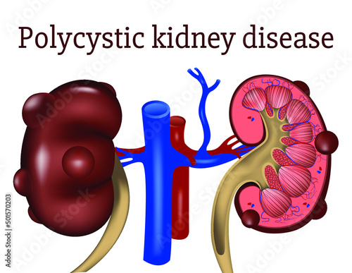 Polycystic kidney disease. genetic disease. Infographics of organs with cysts. Medical banner. Vector illustration