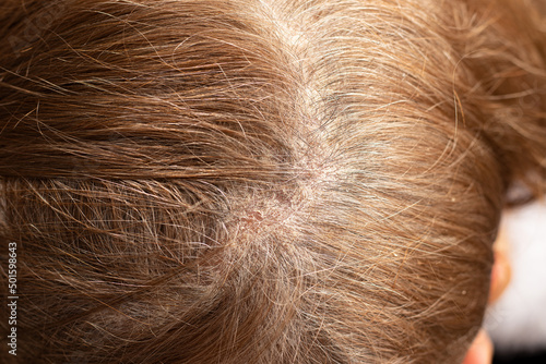 Seborrhea dermatitis condition on female's scalp. A close-up of an irritated itchy scalp with red scabs. Skin problem in a human head.