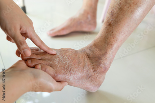 Obraz na płótnie Hands of doctor or nurse examining the dry,cracked,swollen feet of old elderly p