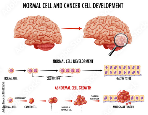 Diagram showing normal cell and cancer cell