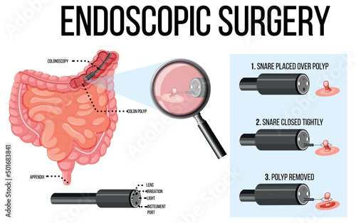 Diagram showing endoscopic surgery