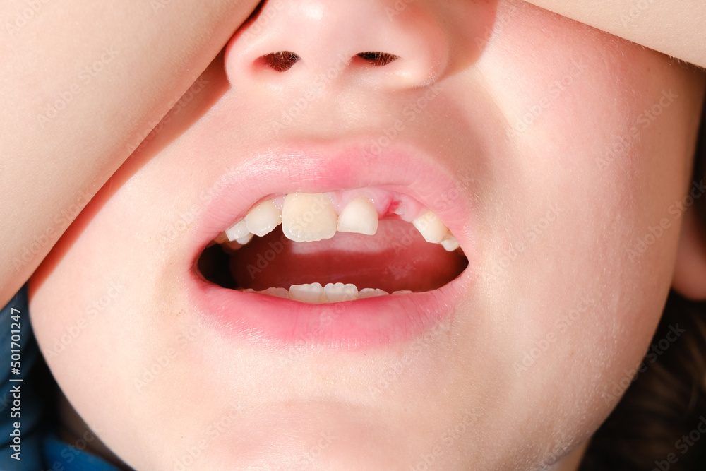 Obraz premium A child lost a baby tooth, shows it with his mouth open.