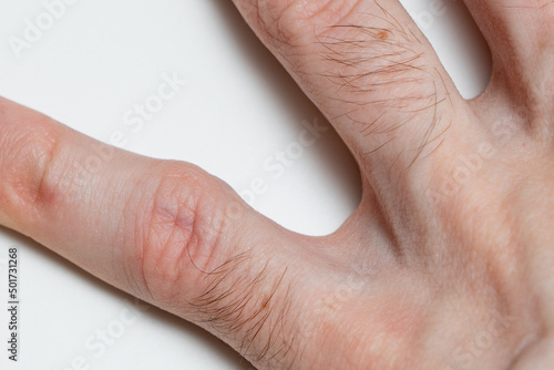 A protruding bone on the finger of the hand. Incorrect bone fusion. Recovery after a broken finger. Problems with genetics. Improper metabolism. Close up. photo