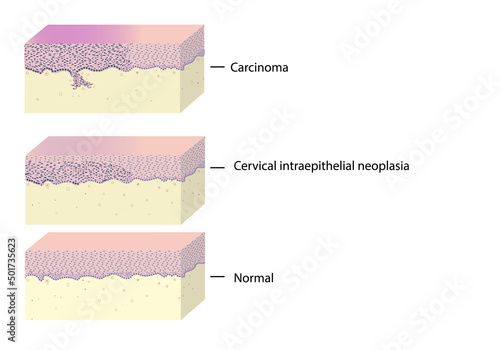 morphology of cervical cancer and cancerogenesis under a microscope, illustration, vector