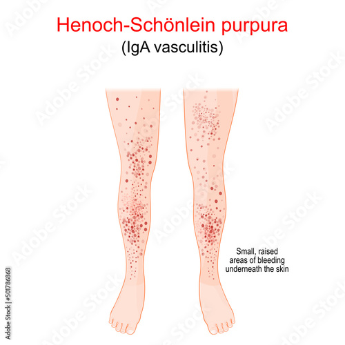 Henoch-Schönlein purpura. Spotty rash on the humans legs