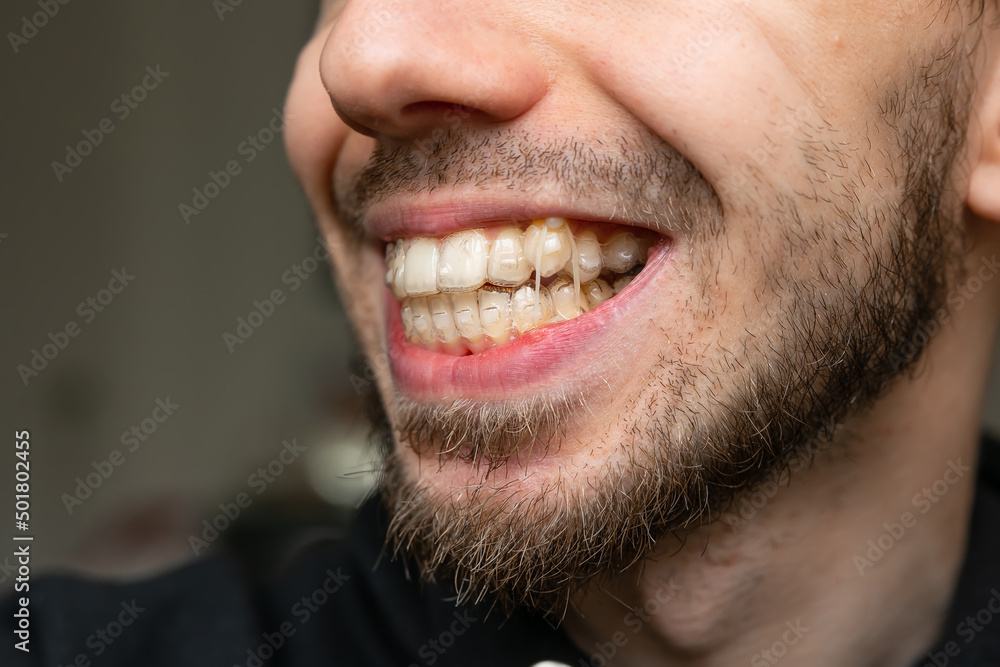 unrecognizable dark-haired man with beard with transparent dental retainer unrecognizable dark-haired man with beard with transparent dental retainer