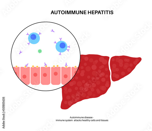 Autoimmune hepatitis disease