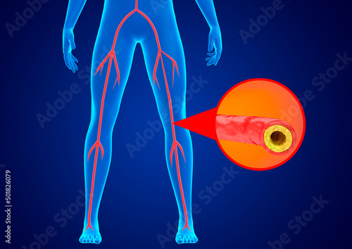 Peripheral arterial disease is the accumulation of fat and calcium in the walls of the arteries of the lower limbs preventing blood flow
