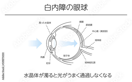 図解、白内障の眼球、メディカルイラスト