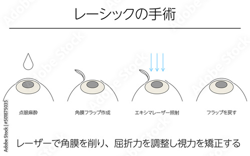 図解、レーシックによる視力矯正、メディカルイラスト