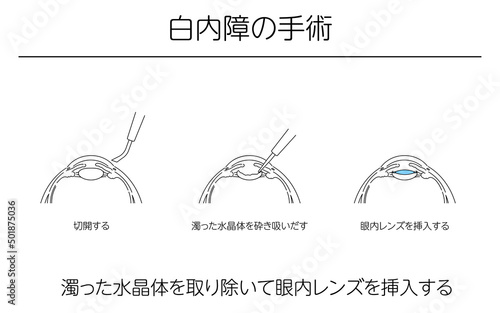図解、緑内障の手術、メディカルイラスト