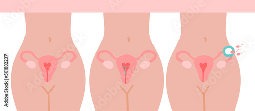 Fertilization icon. Uterus, sperm, insemination. Fertilization in the fallopian tube. The method of IUD contraception is not isolated.
