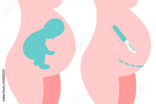Breech presentation. Fetal baby positions in the uterus during pregnancy. Cesarean section flat icon. Scalpel near belly. Surgical operation for childbirth.