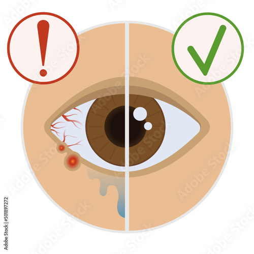 eye disease