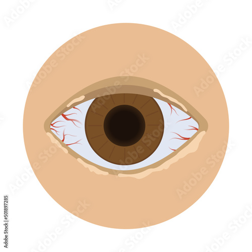 pus on the eyes