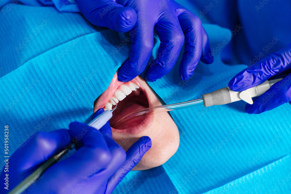 hands with gloves checking teeth of a patient, caries concept. hands with gloves checking teeth of a patient, caries concept.