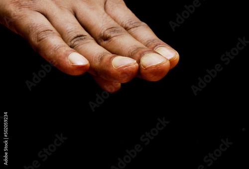 Finger nails of a man having spoon finger or clubbed finger. Clubbed fingers is a symptom of disease, often of the heart or lungs which cause chronically low blood levels of oxygen. 
