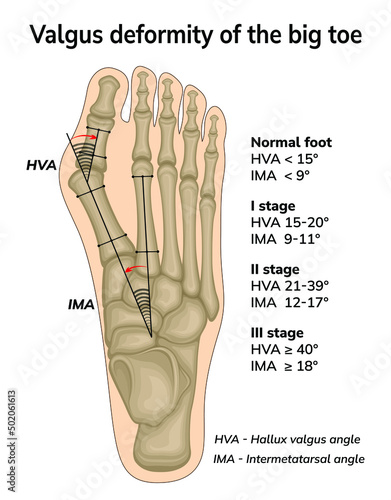 Illustration of valgus deformity of the big toe. The angles of bone displacement during deformation are shown
