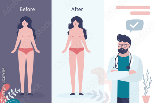 Plastic surgeon demonstrates results of mammary glands augmentation surgery. Before and after breast enlargement surgery. Woman after boobs implant operation. Mammoplasty, infographic.