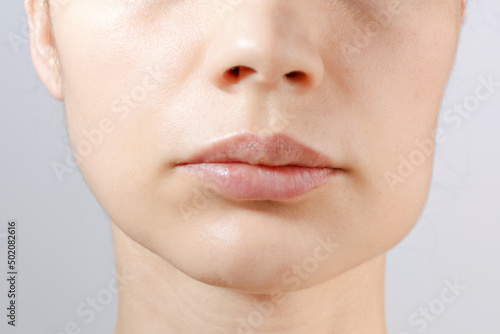 Closeup of down part of females face of suffering from strong tooth pain. Consept of the cheek swelling, teeth problem: gumboil, flux, dental health and care. 1 day after surgery.