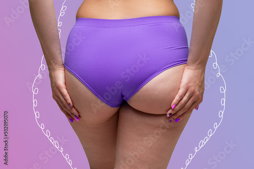Buttocks liposuction, fat and cellulite removal concept, overweight female body with painted lines