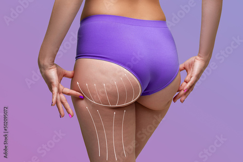 Buttocks liposuction, fat and cellulite removal concept, overweight female body with painted surgical lines and arrows