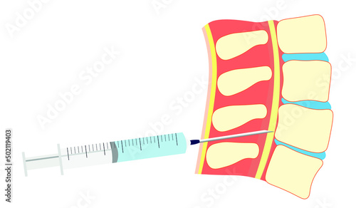 Spinal needle position in a Spinal. Spinal injection with a syringe  
