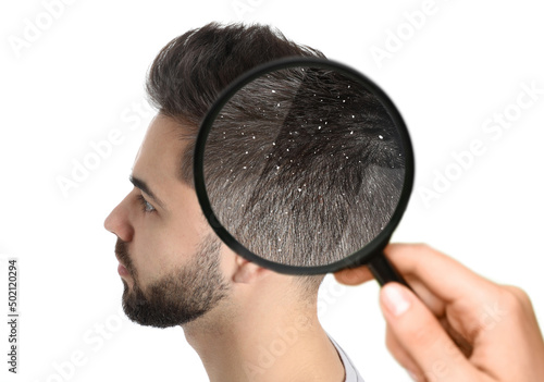 Looking at young man's hair through magnifier on white background. Problem of dandruff photo