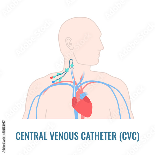 Central venous catheter placed in the jugular vein. Man with CVC access device. Internal jugular venous IJV cannulation procedure. Medical vector illustration.