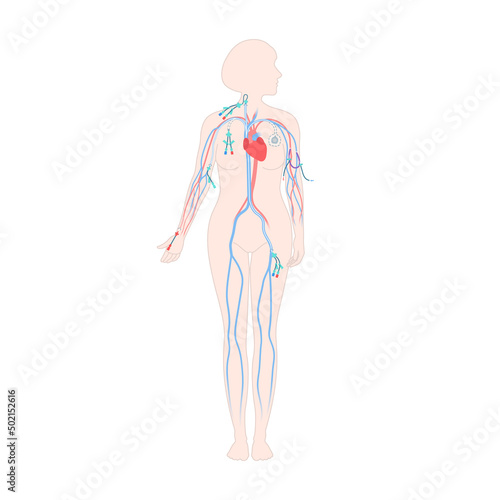 Central venous catheter placement sites shown on the female body. Types of central lines. Woman with CVC access devices. PICC, arterial line, implanted port for infusion. Medical vector illustration.