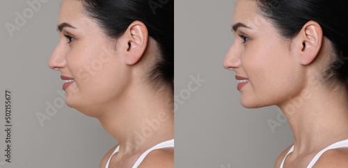 Canvas Print Double chin problem