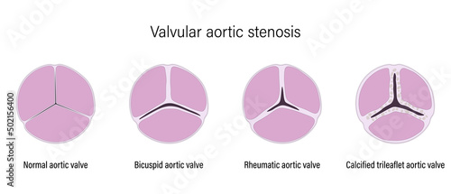 Valvular aortic stenosis. Normal aortic valve, Bicuspid aortic valve, Rheumatic aortic valve and Calcified trileaflet aortic valve.