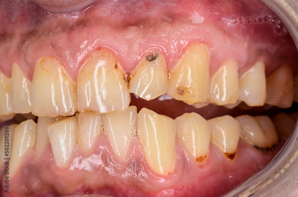 Obraz premium broken end of tooth 22