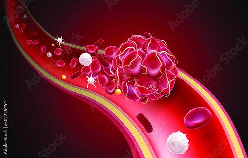 3D illustration of a blood clot in a blood vessel showing a blocked blood flow with platelets and white blood cells in the image. medical use education and science