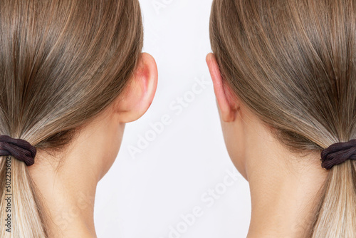 Cropped shot of woman's head with ears before and after otoplasty isolated on a white background. Result of cosmetic plastic surgery of correction auricles and getting rid of lop - eared photo