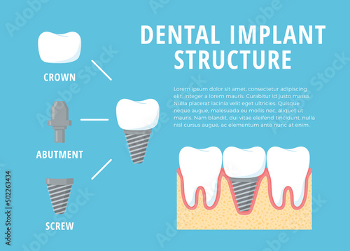 Sick tooth treatment, dental implant, dental procedure, dentures, vector flat illustration