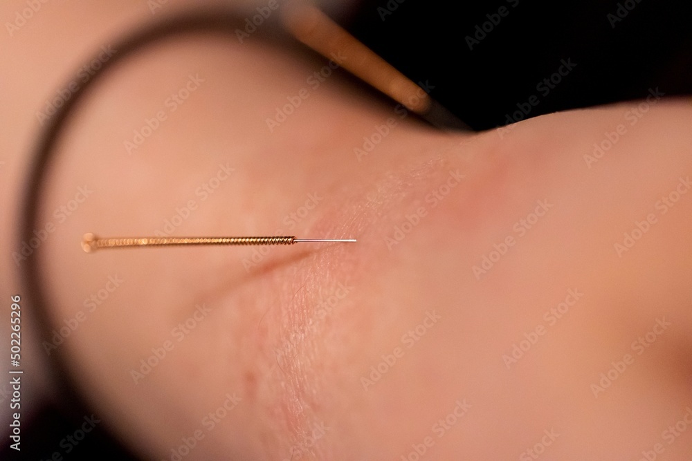 © Joeri - A portrait of a thin acupuncture needle placed below the wrist, put in place by an acupuncturist. This alternative medicine treatment is used for healing, relaxing, stimulation and stress relief.
