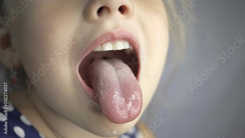 kid salivation girl opens her mouth child shows his teeth soft palate and mouth to dentist. mouth is wide open, tongue is stuck out as far as possible, with clear view of tongue photo