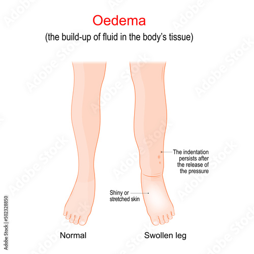 Edema. Swollen ankles, feet and legs. oedema photo