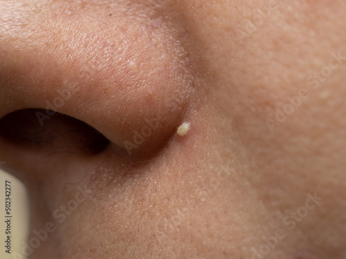 acne on the skin of the face as a background
