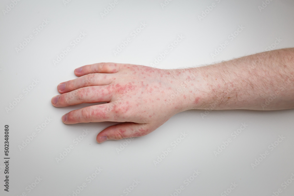 Patient shows arm and hand with red itchy painful rash. Allergic symptom on male hands. Dermatology, skin care. White background, top view Patient shows arm and hand with red itchy painful rash. Allergic symptom on male hands. Dermatology, skin care. White background, top view