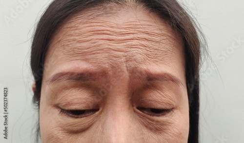 portrait showing skin weakness of forehead , problem flabbiness and wrinkles skin on the face of the woman, concept health care.