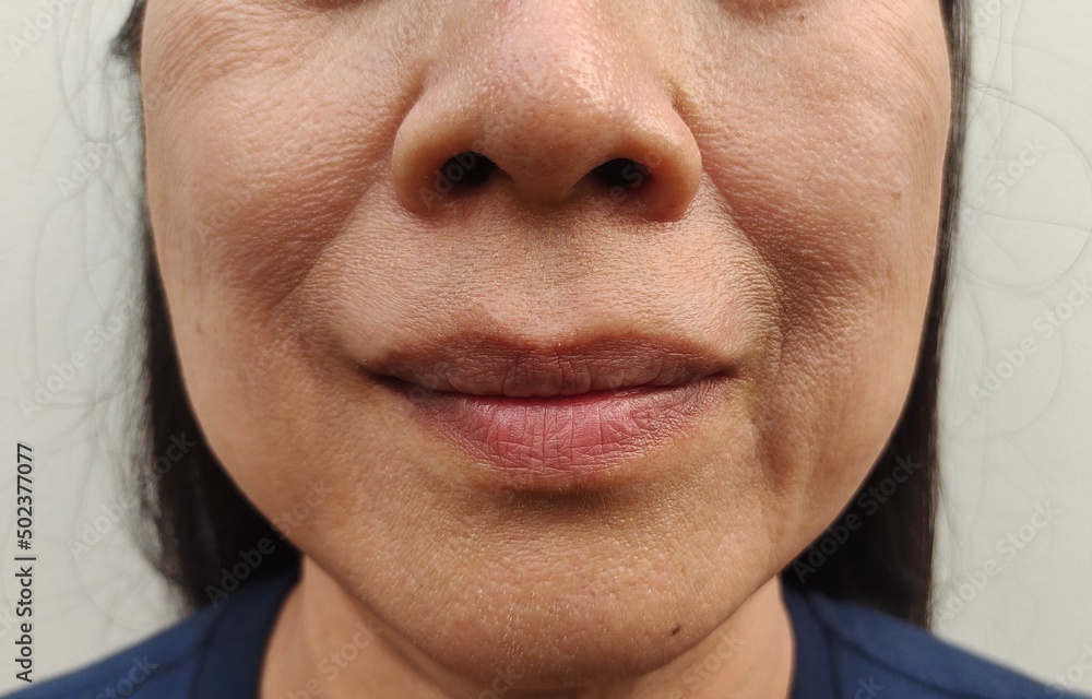 Obraz premium Portrait showing the flabbiness adipose hanging beside the mouth, problem wrinkles and sagging skin of the woman, concept health care.