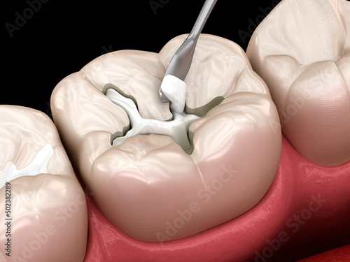 Decayed tooth restoration with composite filling. Dental 3D illustration photo