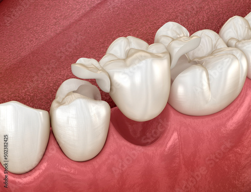 Maryland bridge made from ceramic, premolar tooth recovery. Dental 3D illustration