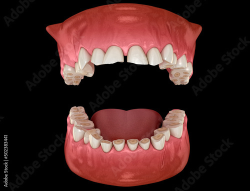 Dental attrition (Bruxism) resulting in loss of tooth tissue. Dental 3D illustration photo