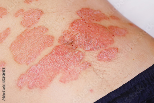 Acute psoriasis on the stomach in a man, severe redness on the skin, an autoimmune incurable dermatological skin disease. Red redness, spots on the skin.Large red inflamed scaly rash on the stomach. photo